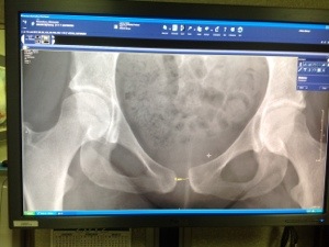 iPad photo of my x-ray