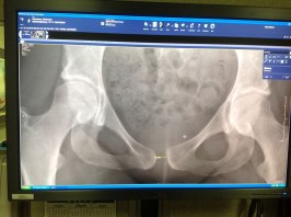 Picture of my x-ray displayed on monitor