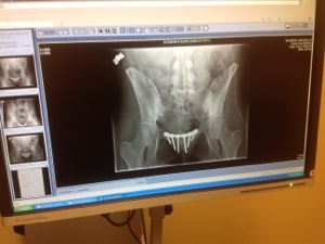 My new pelvis - x-ray image of plate and screws
