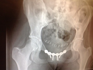 after surgery - no separation at pubis symphysis, but a plate and six screws.