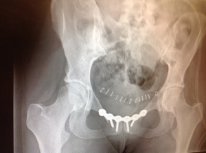 X-ray of my pelvis with plate, screws and staples visible